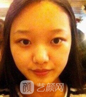 實拍隆鼻拆線后鼻子恢復(fù)果圖片