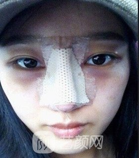 實拍隆鼻拆線后鼻子恢復(fù)果圖片