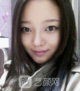 實拍隆鼻拆線后鼻子恢復(fù)果圖片