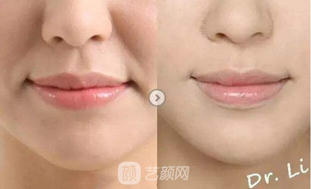 北京伊美康自體脂肪填充術后果