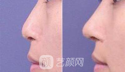看我的韓式鼻子整形對(duì)照?qǐng)D