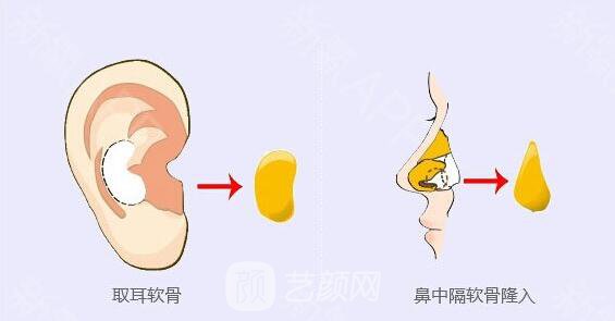 軟骨移植重塑鼻尖適應哪些人?