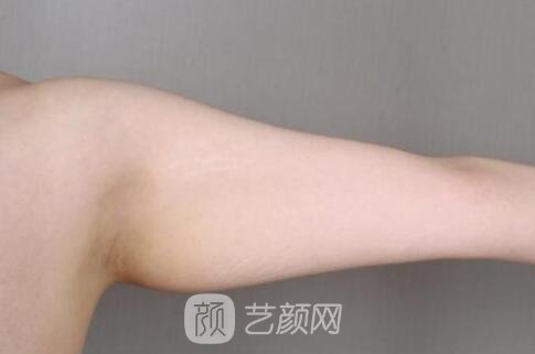 第一次去整形，做了上臂吸脂，自我感覺果很好哈哈