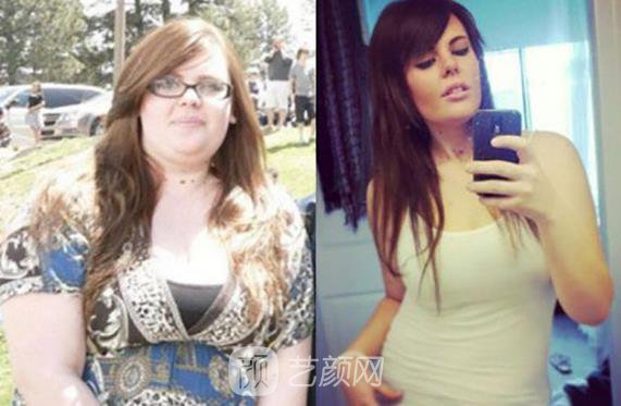 面部吸脂一個(gè)月后果圖