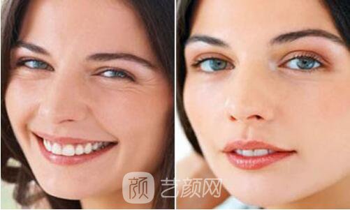 自體脂肪填充童顏術(shù)，讓我也逆生長了一回