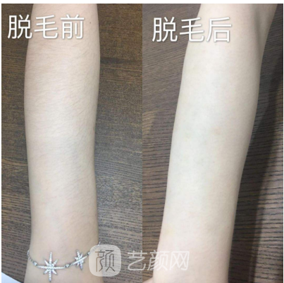 深圳翠綠寶石激光脫毛如何？我們一起來了解一下