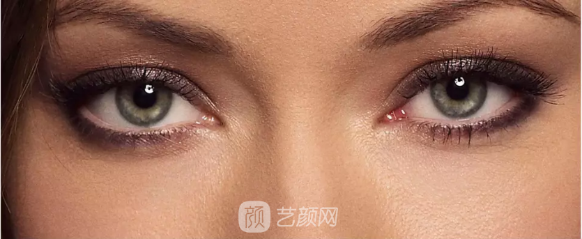 雙眼皮手術(shù)類型太多，怎么選擇?