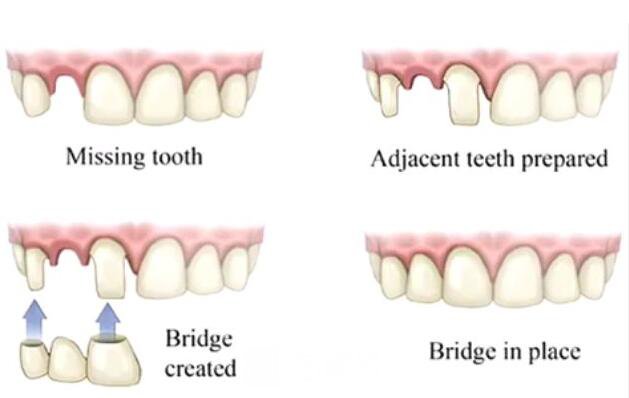 做容冠，牙齒整齊又漂亮~