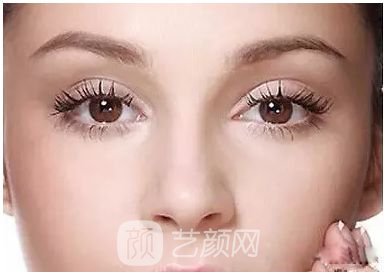 做完雙眼皮兩個(gè)月，簡(jiǎn)直跟換了個(gè)人似的