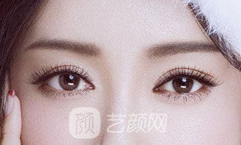 做完雙眼皮兩個(gè)月，簡(jiǎn)直跟換了個(gè)人似的