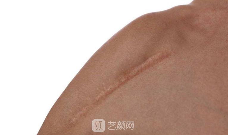 杭州激光去疤費用，多久見