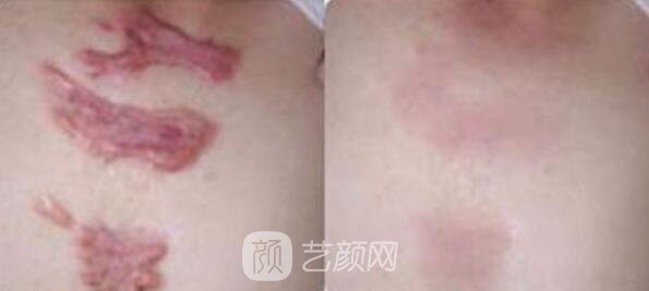 杭州激光去疤費用，多久見