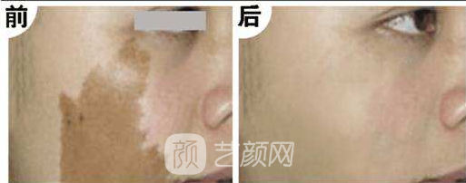 湖南激光祛斑好嗎？