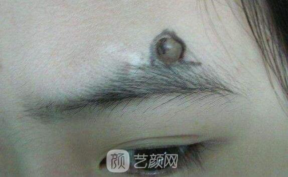 西安那里去痣更好，讓我這個(gè)專業(yè)醫(yī)生來(lái)告訴你