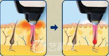 成都地區(qū)激光脫毛的價(jià)格是多少？