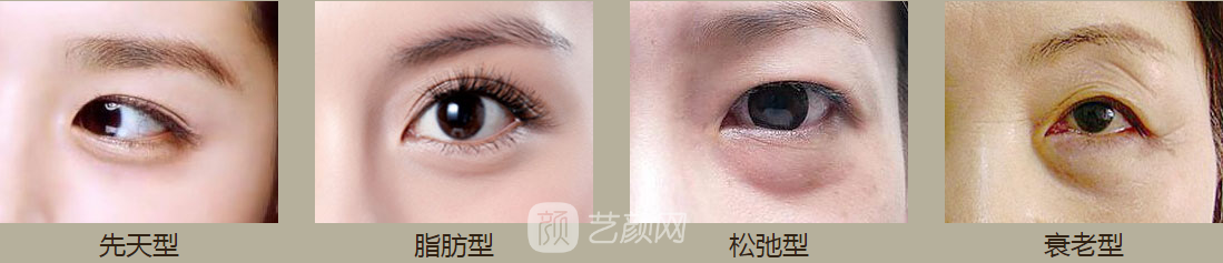 麗江哪個醫(yī)院做去眼袋的手術(shù)好