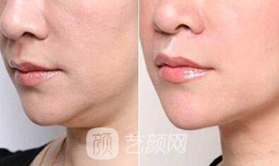 上海溶脂價(jià)格為什么沒有統(tǒng)一，當(dāng)?shù)爻錾t(yī)生為你解答