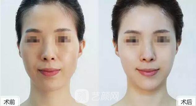 玻尿酸到底是什么東西，小編為你解剖分析