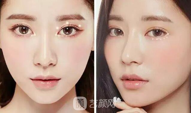 韓式切開(kāi)雙眼皮的真實(shí)過(guò)程及恢復(fù)體驗(yàn)分享~~