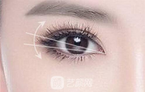 韓式切開(kāi)雙眼皮的真實(shí)過(guò)程及恢復(fù)體驗(yàn)分享~~