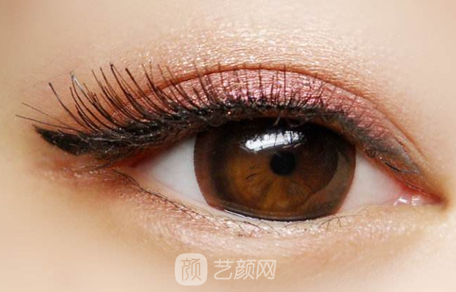 韓式切開(kāi)雙眼皮的真實(shí)過(guò)程及恢復(fù)體驗(yàn)分享~~