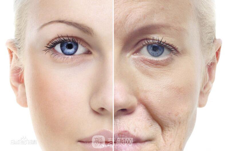 昆明面部填充用自體脂肪好？還是玻尿酸好？