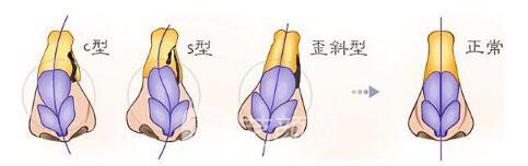 隆鼻失敗修復(fù)案例終于擁有滿意的鼻形