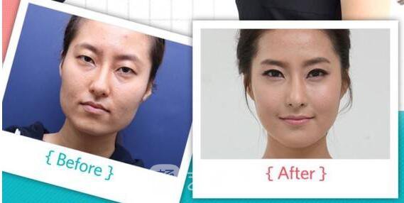 隆鼻失敗修復(fù)案例終于擁有滿意的鼻形