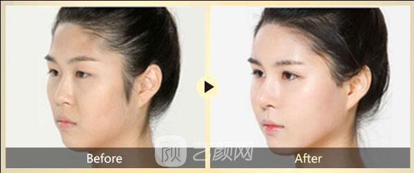 面部去皺術(shù)有很多，選適合自己的才是王道