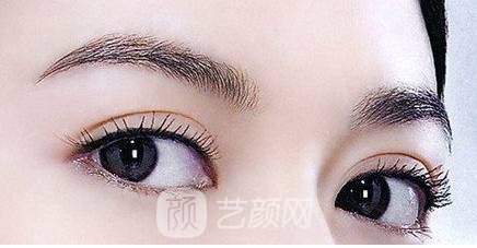 全切雙眼皮手術(shù)案例,全切雙眼皮-秒變女神