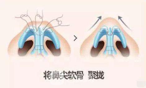 鼻子變高了，氣質(zhì)變贊了，魅力無限被放大