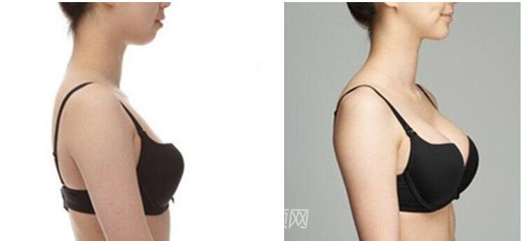 假體隆胸成就我的辣媽夢(mèng)！