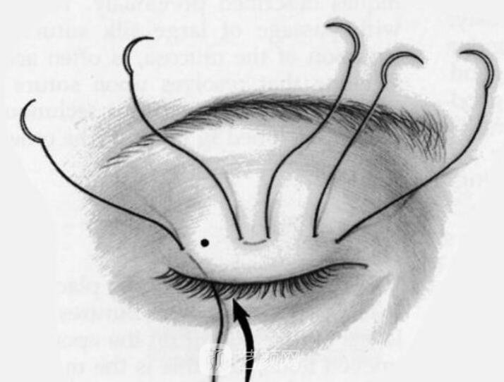 雙眼皮的恢復(fù)與外界影響有關(guān)嗎？