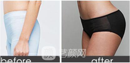 重慶埋線減肥怎么樣？