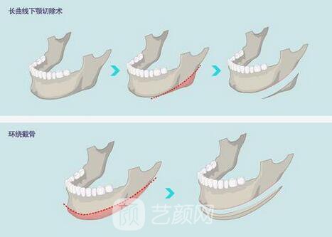 西昌整形專家湯穎峰：如何減少腮腺和頜下腺肥大？