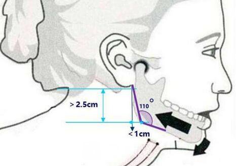 西昌整形專家湯穎峰：如何減少腮腺和頜下腺肥大？