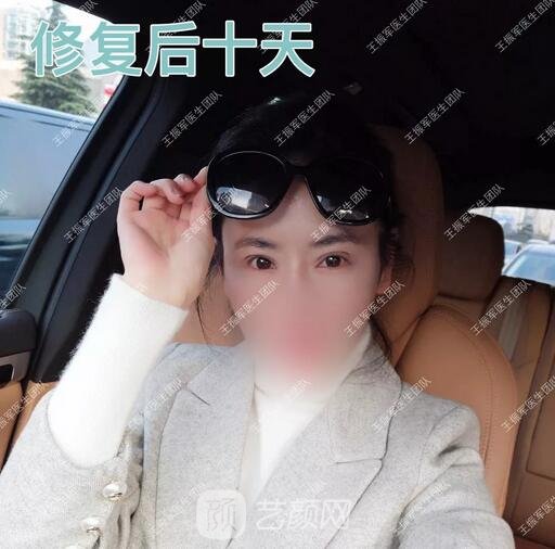 雙眼皮修復(fù)術(shù)后十天果圖