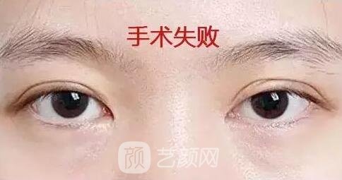 雙眼皮失敗的情況