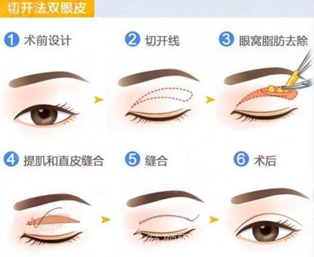 全切雙眼皮手術流程