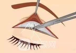 全切雙眼皮手術