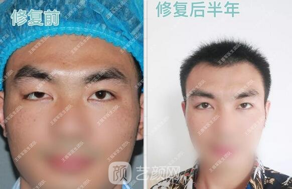 雙眼皮上瞼下垂矯正術(shù)