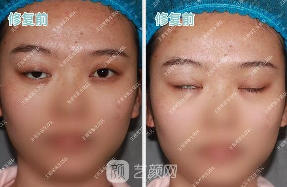雙眼皮修復術前