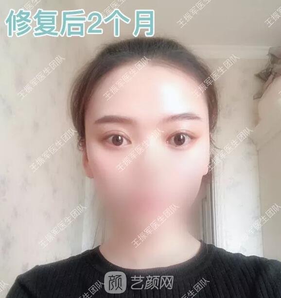 雙眼皮修復術后兩個月果