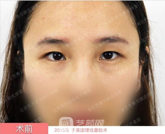 修復雙眼皮術前照