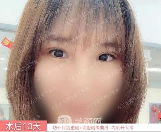 修復雙眼皮術后13天果