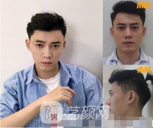 自體脂肪面部填充全臉案例圖