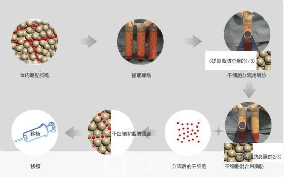 自體脂肪填充流程