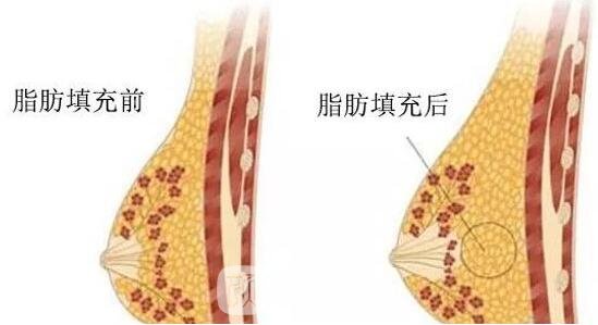 自體脂肪填充隆胸手術(shù)