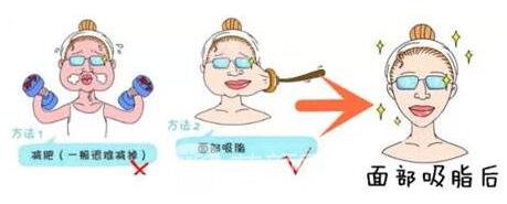 面部吸脂手術(shù)