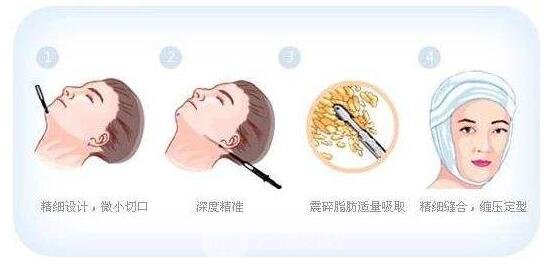 所謂面部吸脂手術(shù)，需要醫(yī)生在手術(shù)前根據(jù)患者自身面部比例的情況